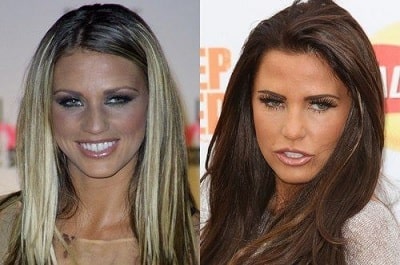 A picture of Katie Price before (left) and after (right).